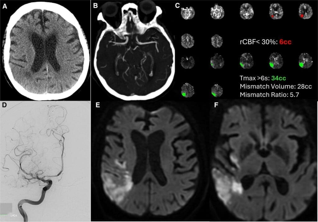 strokeaha.125.053824.fig01-1024x713-1