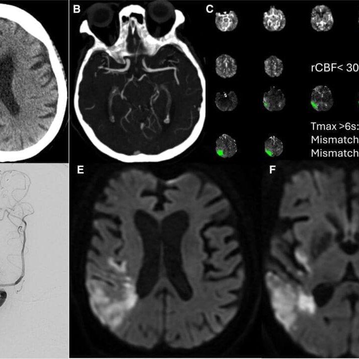 strokeaha.125.053824.fig01-1024x713-1